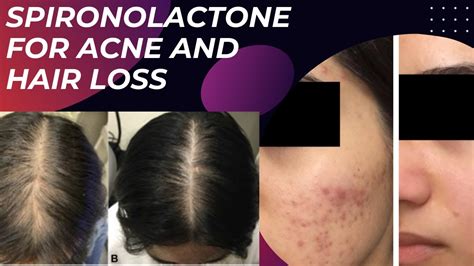 is 25 mg of spironolactone enough for acne